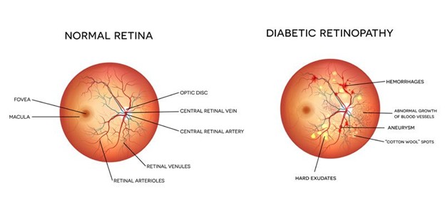 diabetic photo