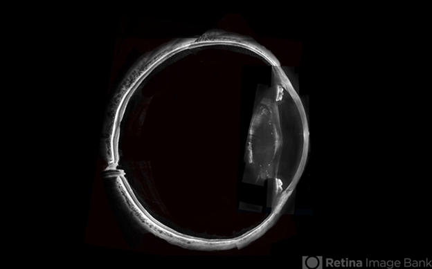 X-ray of an ocular condition cataract Phacoanaphylactic Endophthalmitis